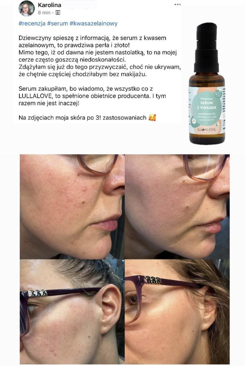 Kwas azelainowy a karmienie piersią