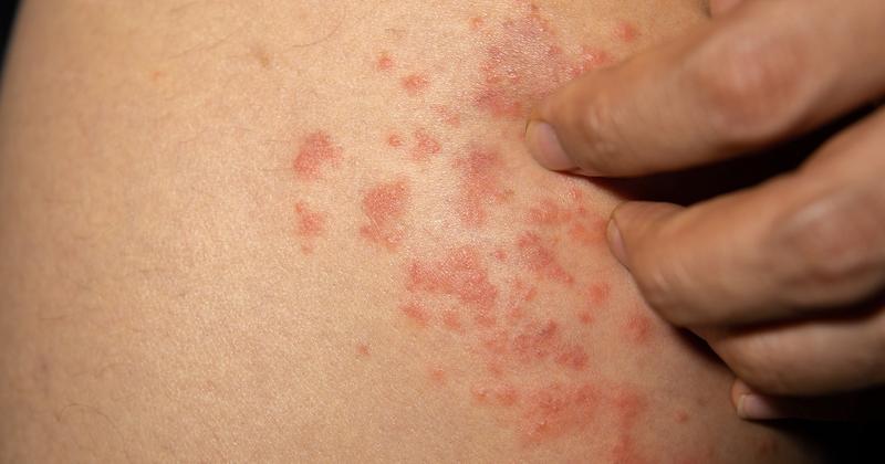 Różnicowanie wysypki u dzieci