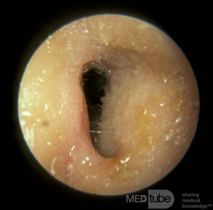 Zapalenie ucha u dzieci