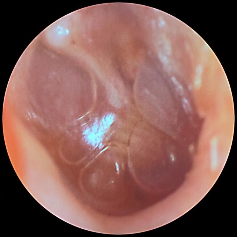 Czy zapalenie ucha u dziecka może być zaraźliwe? Odpowiadamy na najważniejsze pytania