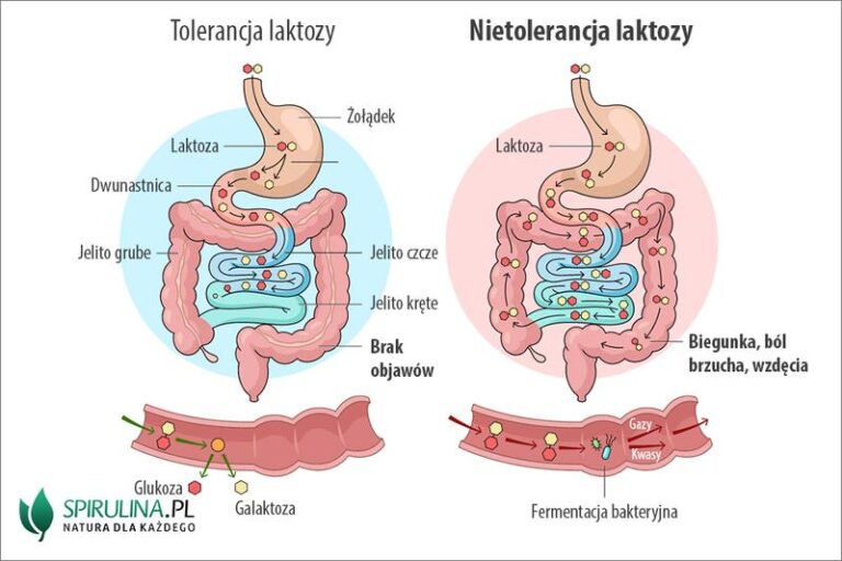Jak rozpoznać objawy nietolerancji laktozy u niemowląt karmionych piersią?