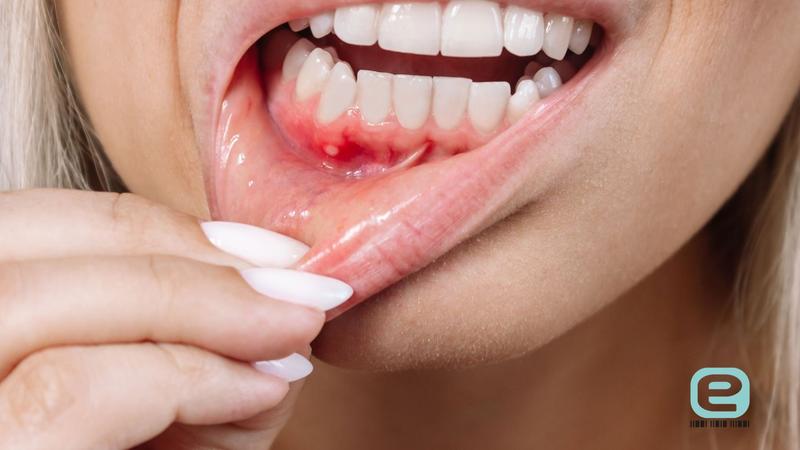 Opryszczka w nosie podczas karmienia piersią