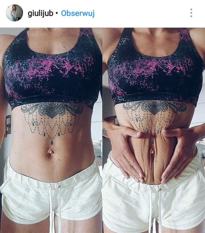 Rehabilitacja poporodowa bioder