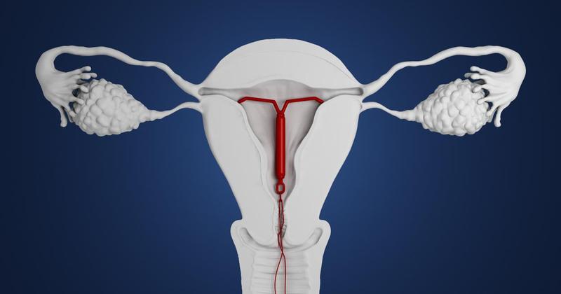 Skuteczność wkładek antykoncepcyjnych