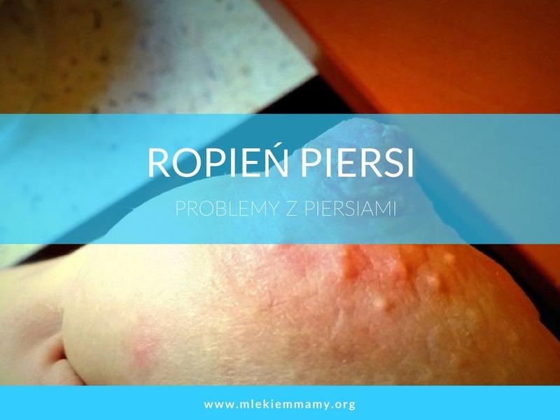 Zapalenie piersi bez karmienia