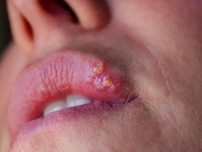 Jak radzić sobie z opryszczką w nosie podczas karmienia piersią?