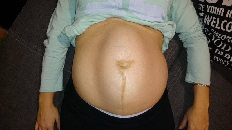 Jak radzić sobie z rozszczepem mięśni po porodzie? Praktyczne porady i ćwiczenia