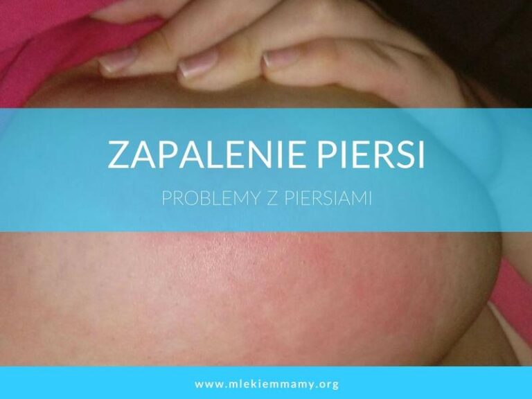 Stan zapalny piersi bez karmienia – jak rozpoznać i leczyć?