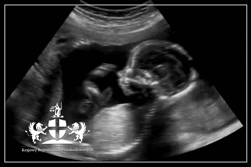 Bezpieczeństwo USG w ciąży