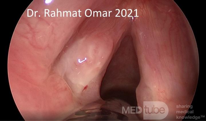 Ból i dyskomfort przy karmieniu piersią