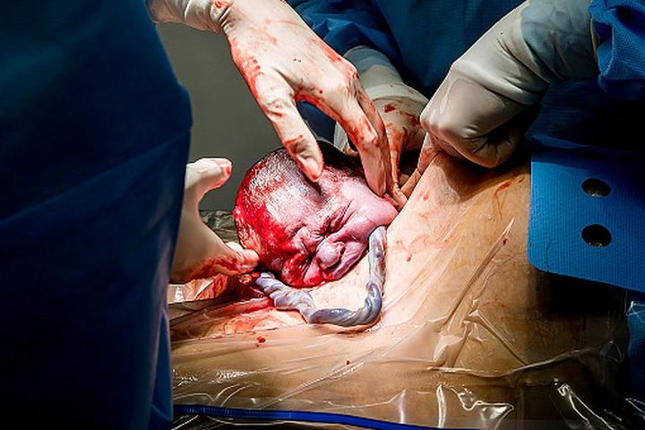 Karmienie piersią po cesarskim cięciu