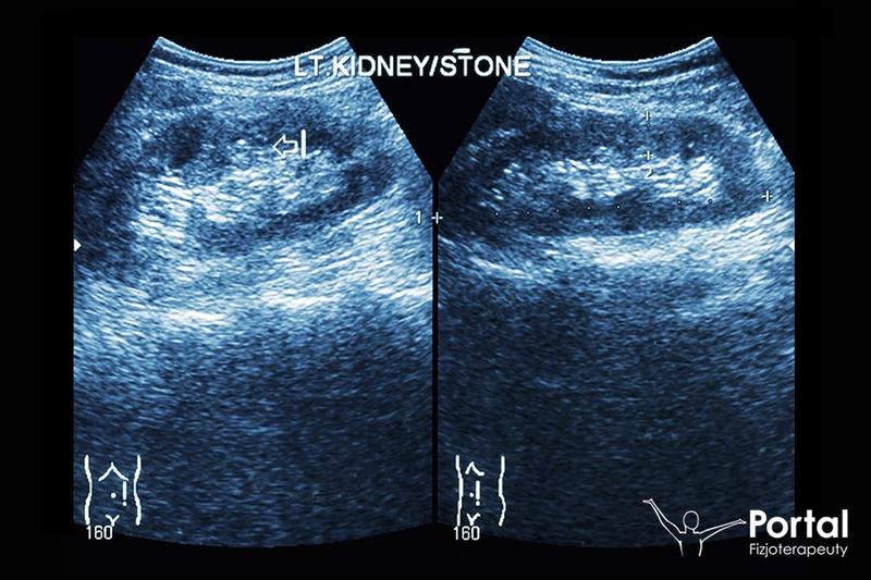 Kolka nerkowa w ciąży