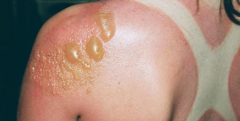 Oparzenia słoneczne u dzieci