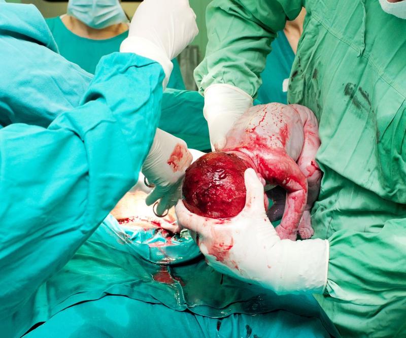 Pęknięcie szyjki macicy po porodzie