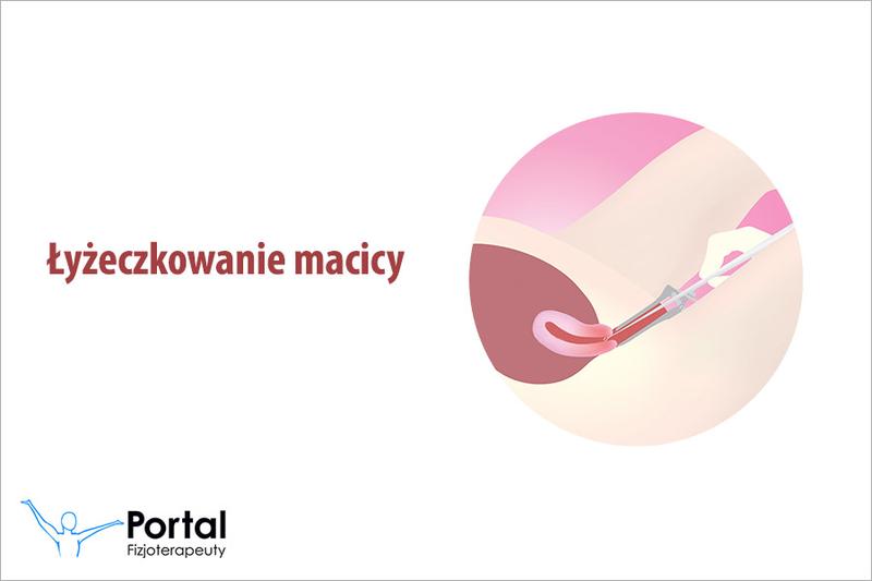 Płodność po łyżeczkowaniu