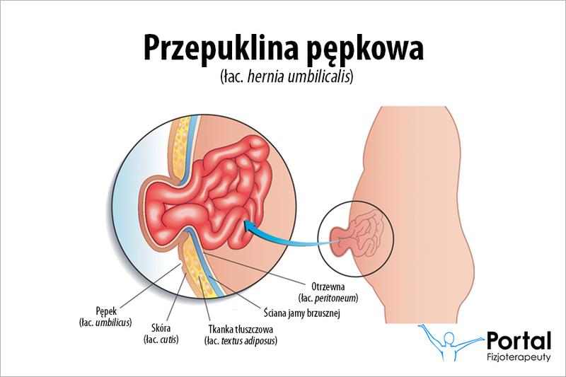 Przepuklina pępkowa po ciąży