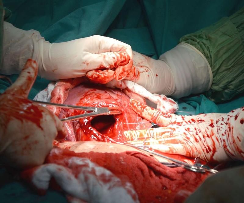 Przyczyny i objawy pęknięć szyjki