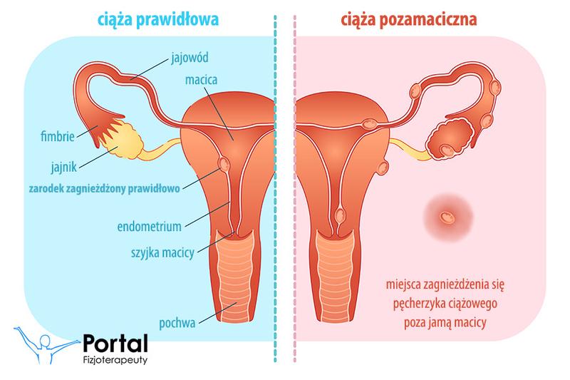 Rehabilitacja poporodowa i gojenie