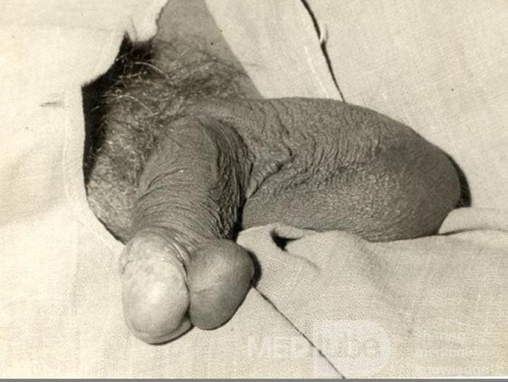 Ściąganie napletka u dzieci