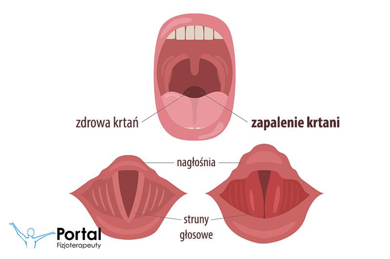 Zapalenie krtani a karmienie piersią