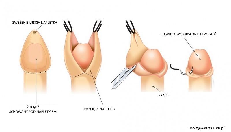 Znaczenie napletka w rozwoju chłopców