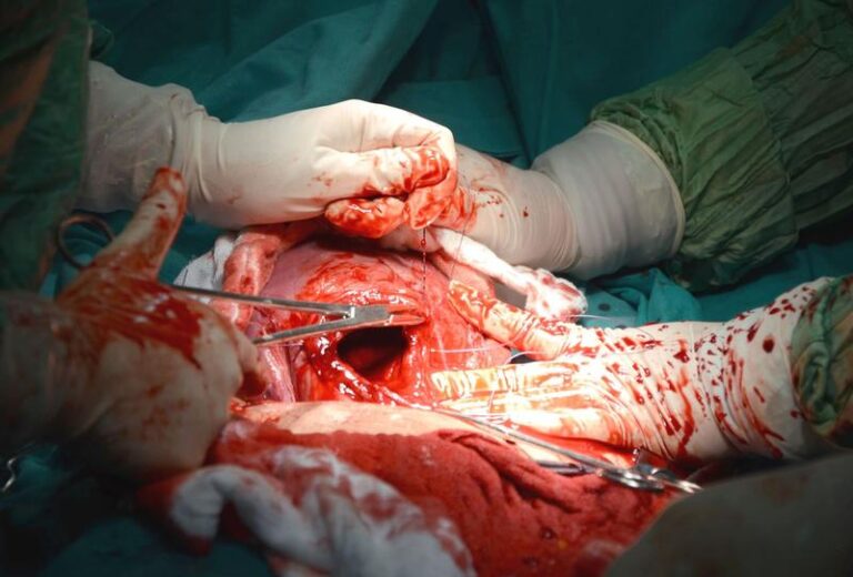 Jak radzić sobie z pękniętą szyjką macicy po porodzie? Poradnik dla mam