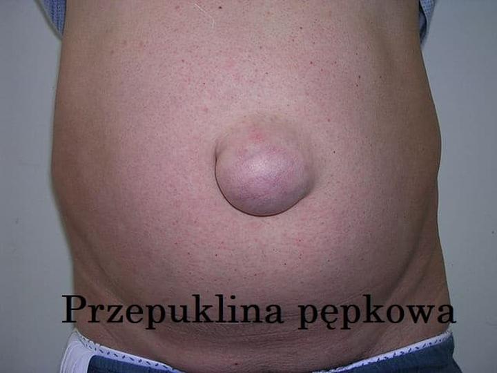 Jak radzić sobie z przepukliną pępkową po ciąży – co warto wiedzieć?