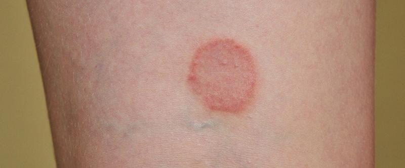 Jak rozpoznać liszaj u dzieci? Przykładowe zdjęcia i porady