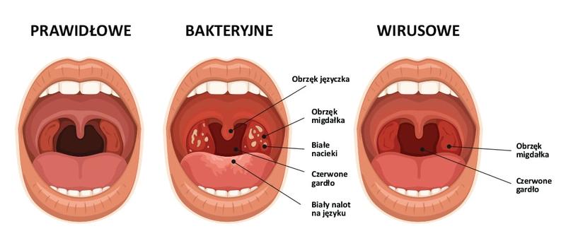Jak zapalenie krtani wpływa na karmienie piersią? Porady dla mam