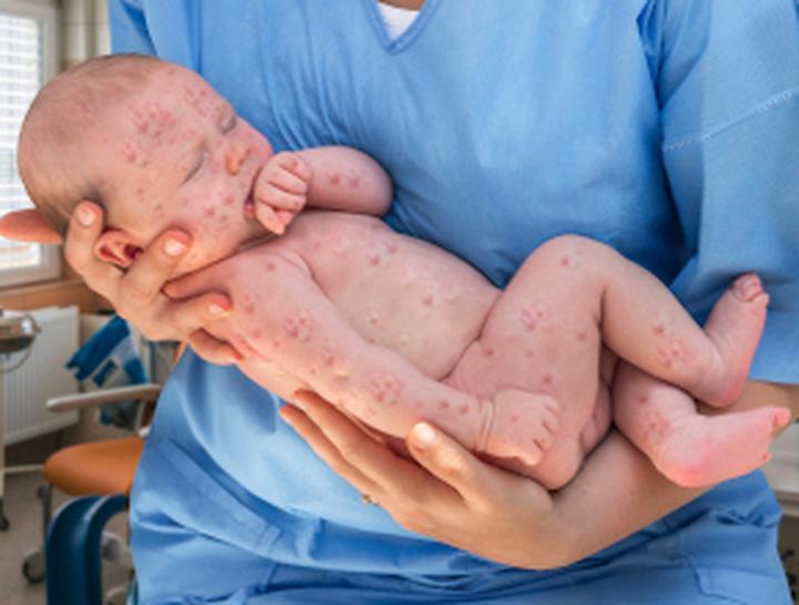 Ospa u noworodka karmionego piersią – co warto wiedzieć, aby chronić maluszka?