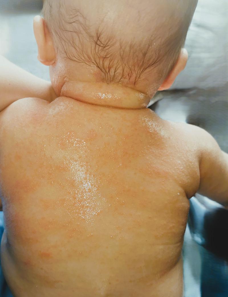 Alergia u niemowlaka