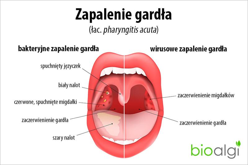 Domowe sposoby na ból gardła