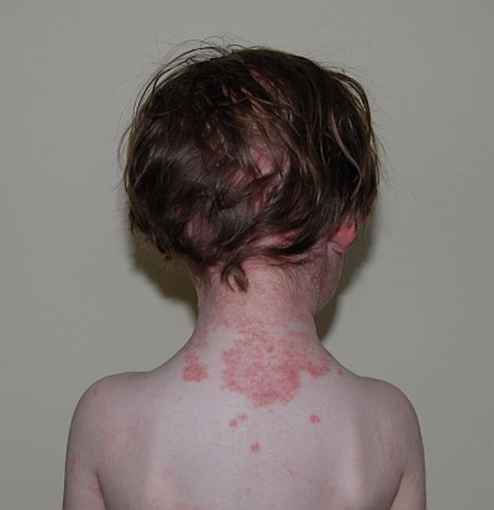 Grzybica skóry u dzieci