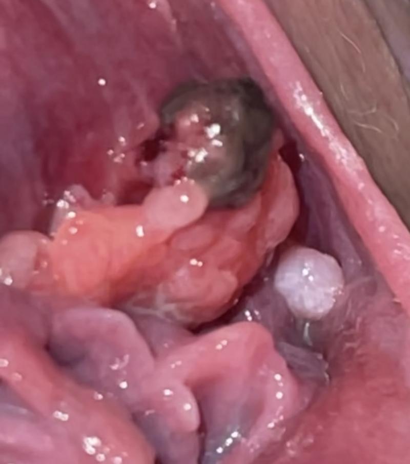 Guzek w pochwie po porodzie