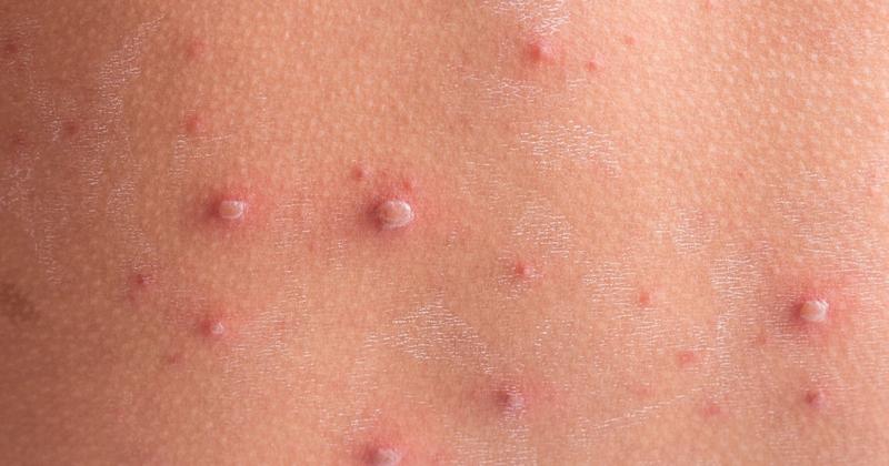 Karmienie piersią a ospa wietrzna