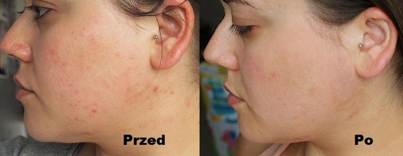 Kwas glikolowy a karmienie piersią