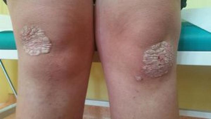 Objawy i diagnostyka grzybicy