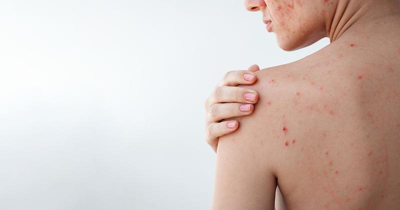 Objawy zmian skórnych