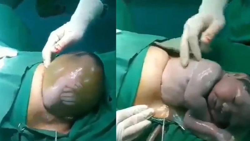 Okres po cesarskim cięciu