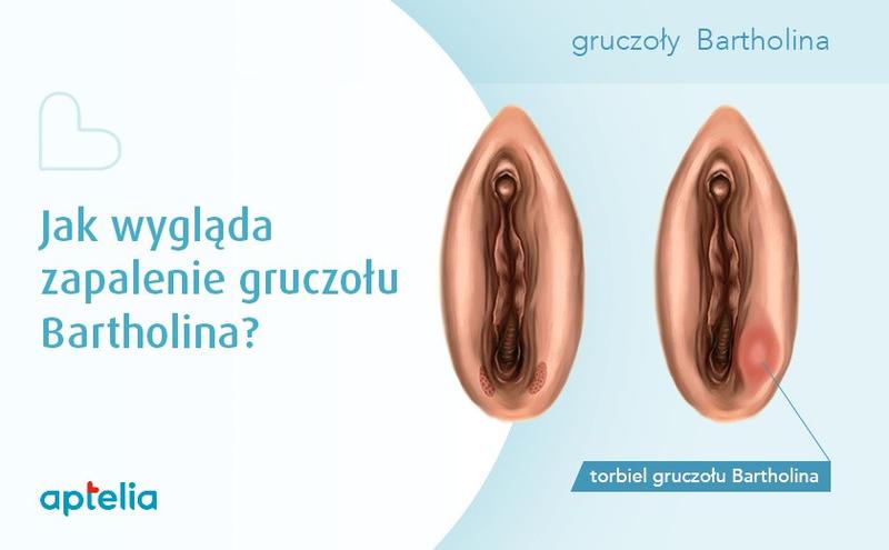 Przyczyny guzków po porodzie