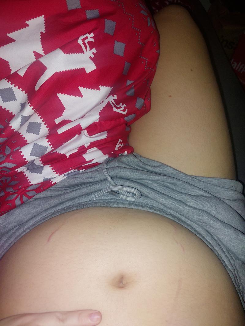 Zapobieganie rozstępom w ciąży