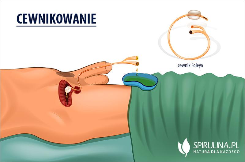 Cewnikowanie po porodzie – co warto wiedzieć dla komfortu matki?