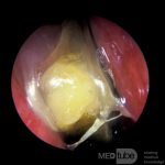 Co oznacza żółty śluz dwa miesiące po porodzie?