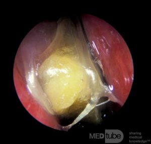 Co oznacza żółty śluz dwa miesiące po porodzie?
