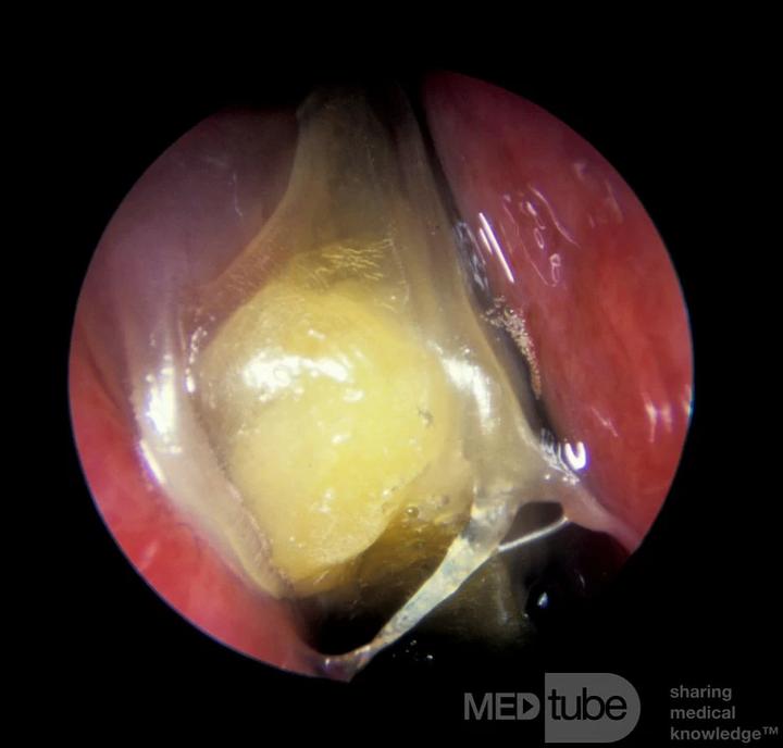 Co oznacza żółty śluz dwa miesiące po porodzie?