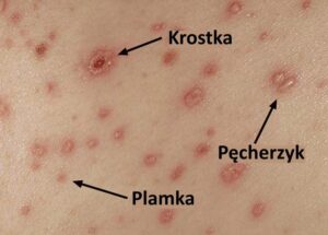 Jak ospa wietrzna wpływa na karmienie piersią?