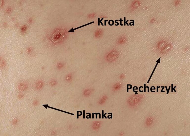 Jak ospa wietrzna wpływa na karmienie piersią?