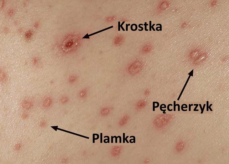 Jak ospa wietrzna wpływa na karmienie piersią?