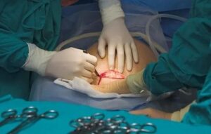 Kiedy możesz spodziewać się okresu po porodzie przez cesarskie cięcie?