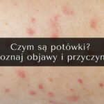 Potówki czy alergia u niemowlaka – jak rozpoznać, co naprawdę dolega twojemu dziecku?